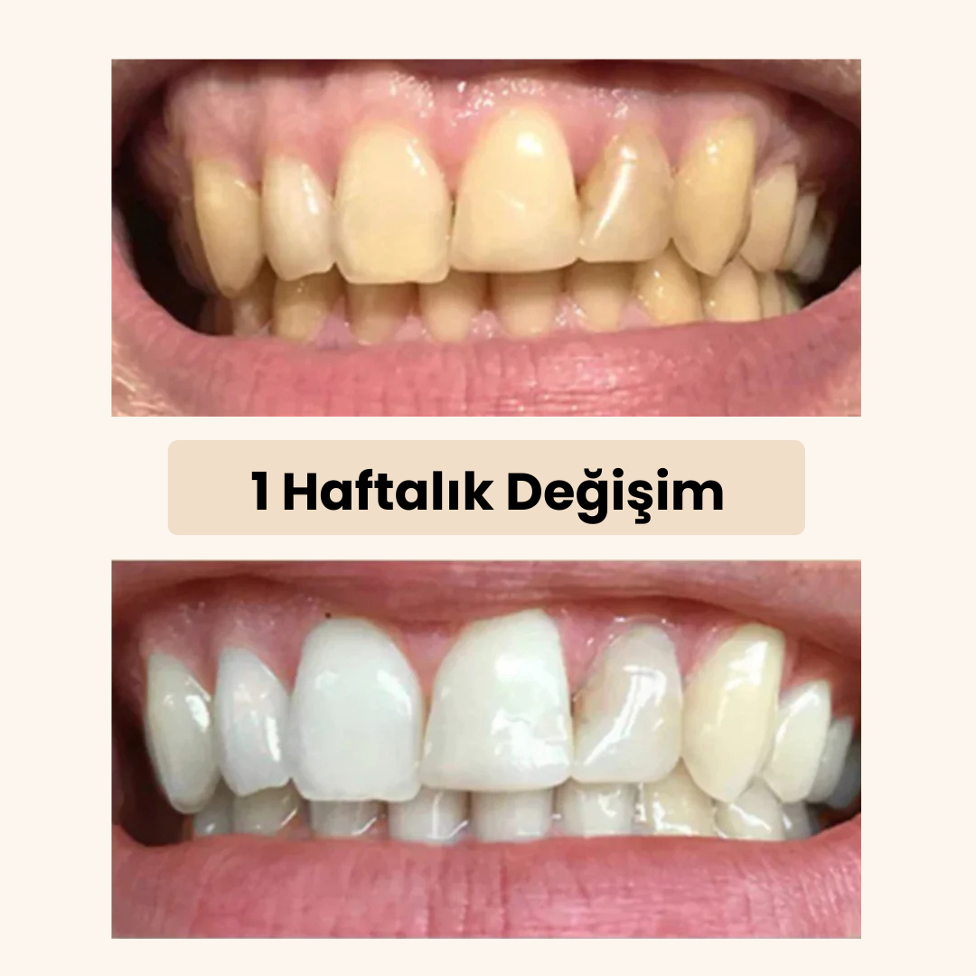 Özmisvak 3'lü Diş Beyazlatma